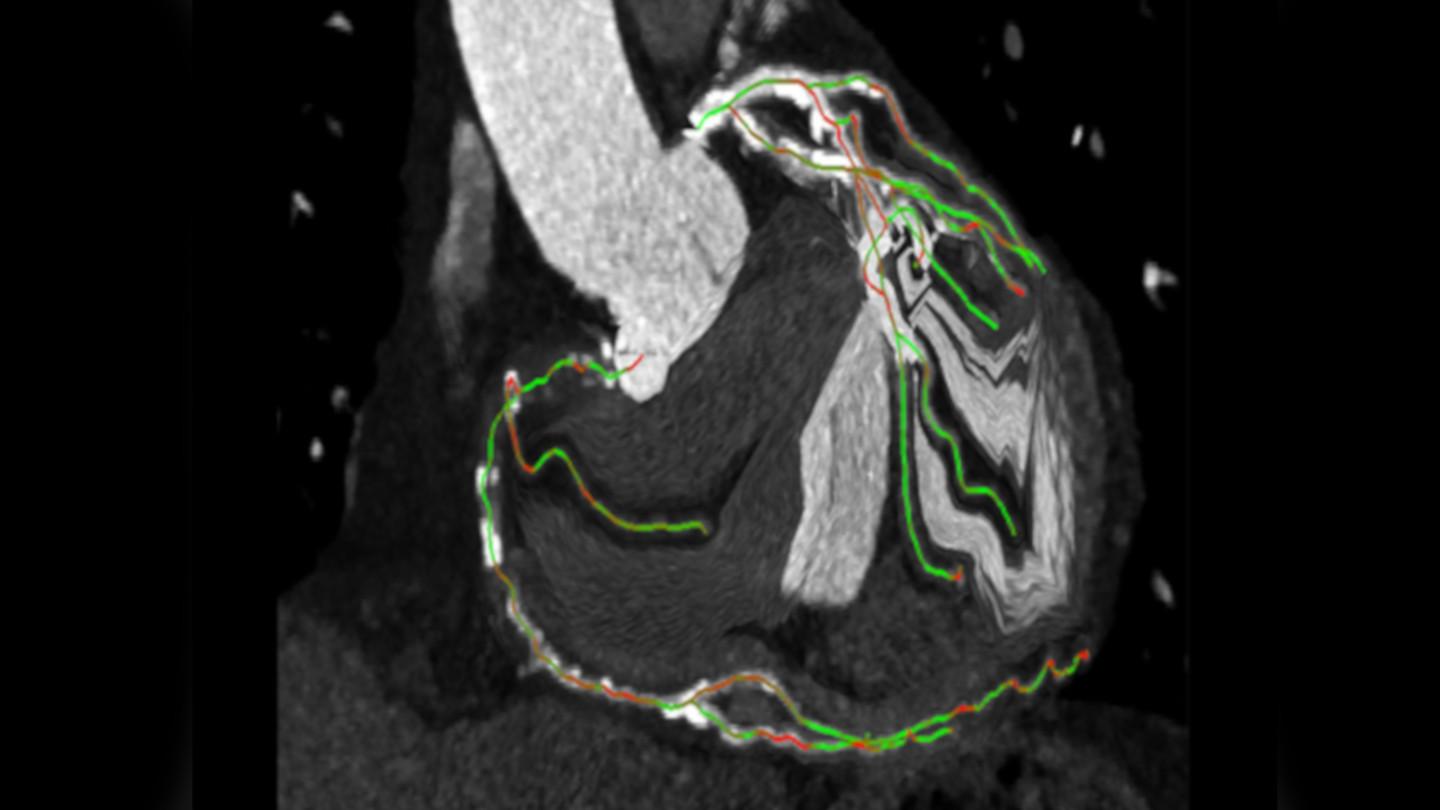 syngo CTO Guidance for automated segmentation of the coronaries