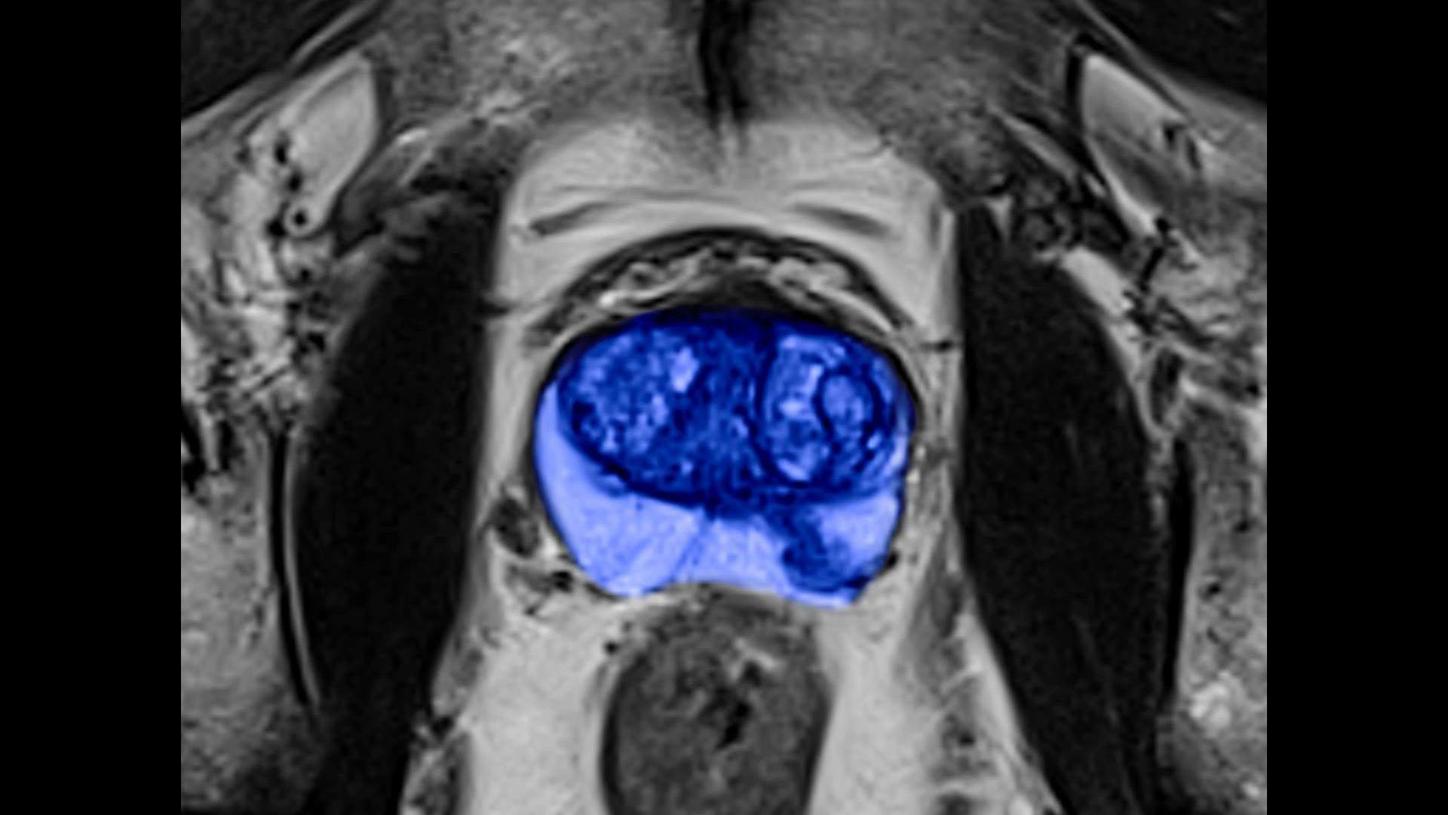Siemens - MRI - Prostate MRI - Image - Teaser