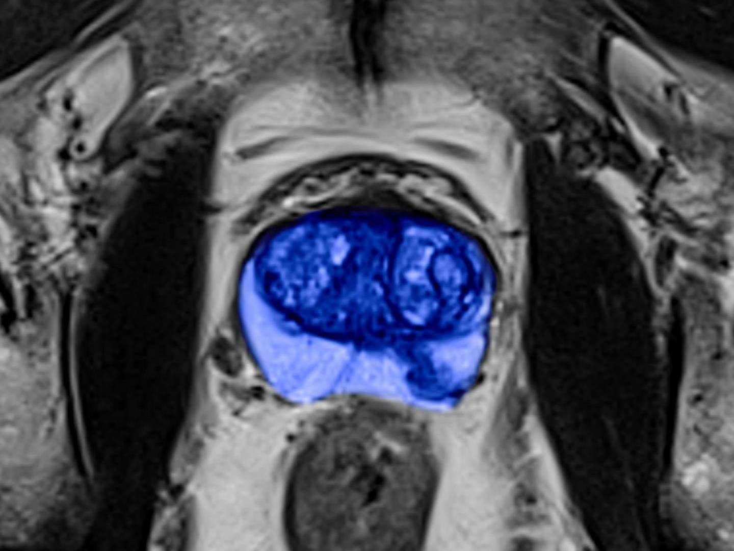 Siemens - MRI - Prostate MRI - Image - Teaser