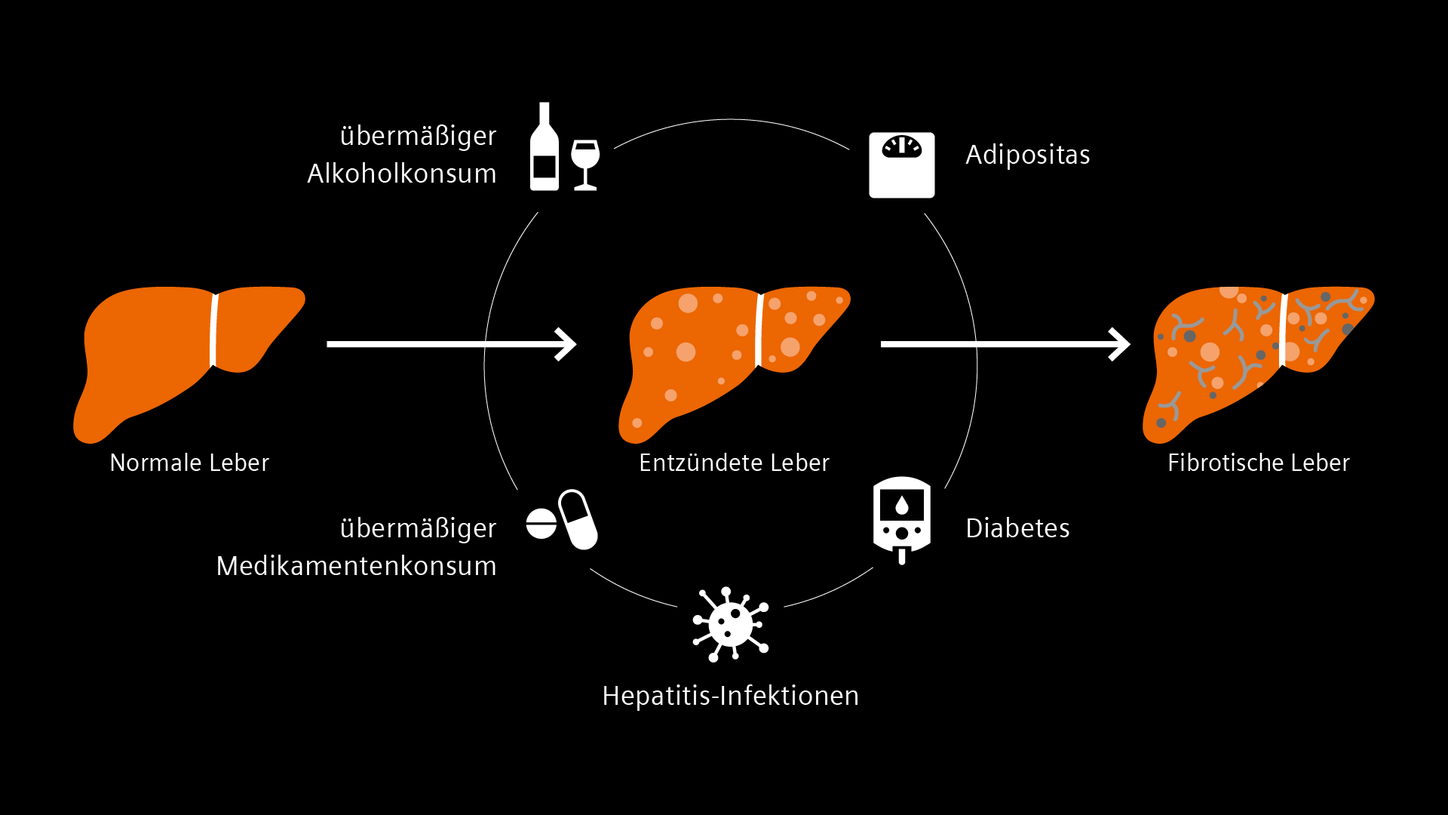 Infografik über die Ursachen von Lebererkrankungen