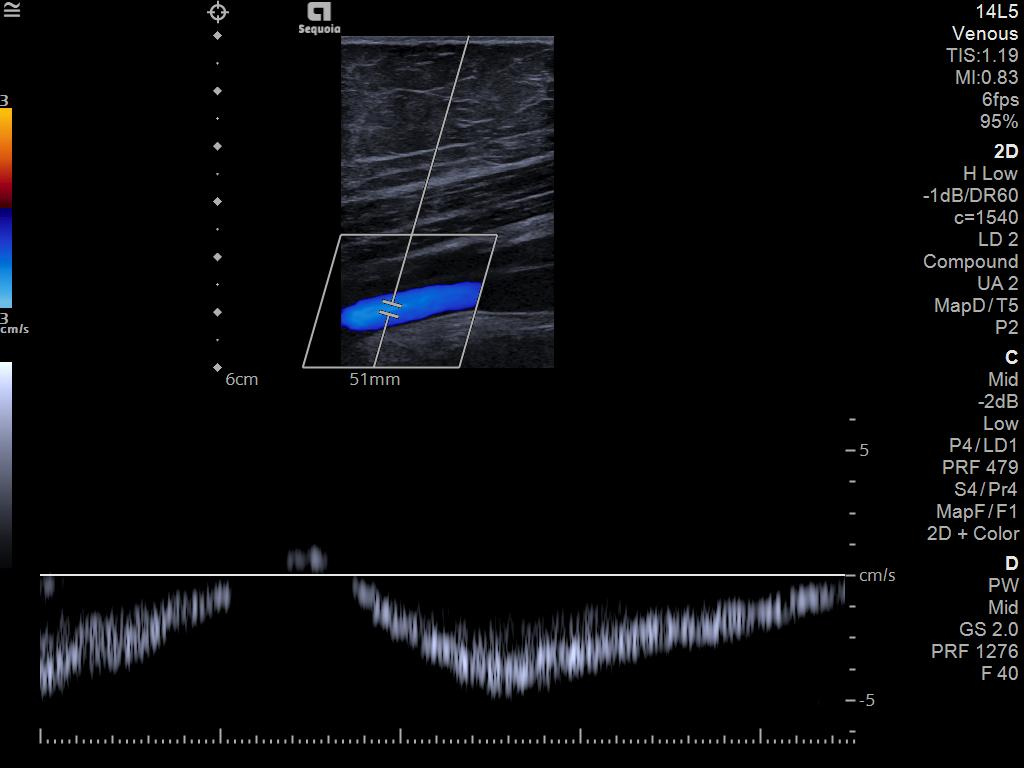 The 14L5 transducer demonstrates the exceptionally clear and detailed spectral Doppler waveform obtained from the superficial femoral vein.