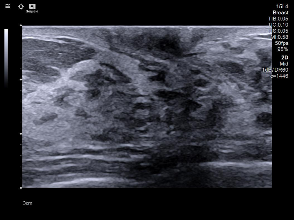 Breast image utilizing the 15L4 transducer demonstrating excellent resolution of tissue behind the nipple.