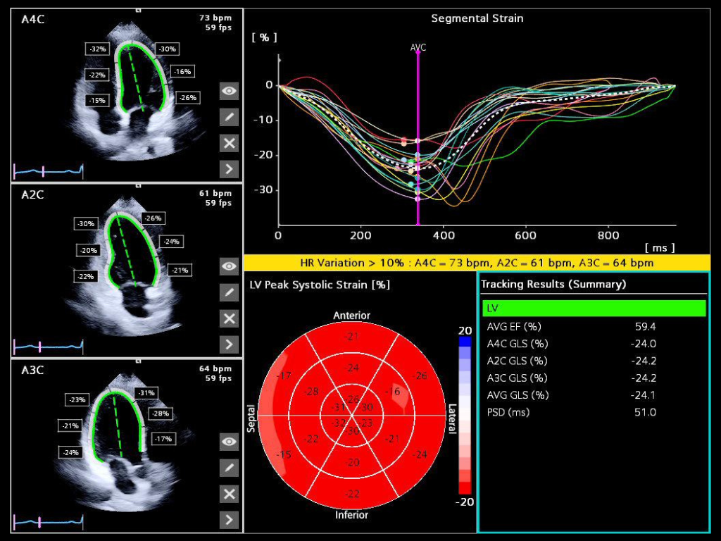 Assess myocardial motion and mechanics with global longitudinal strain (GLS), global circumferential strain (GCS), and global radial strain (GRS) using AI-powered 2D Heart.
