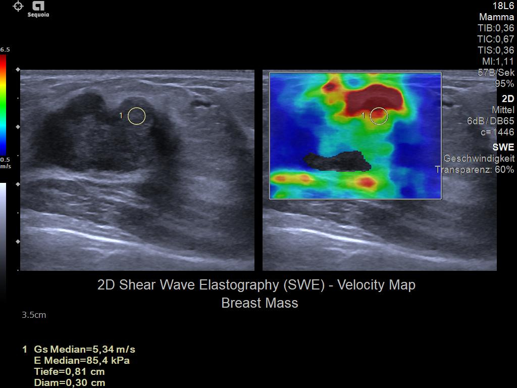 Next Gen 2D SWE for Breast Ultrasound Imaging on the ACUSON Sequoia