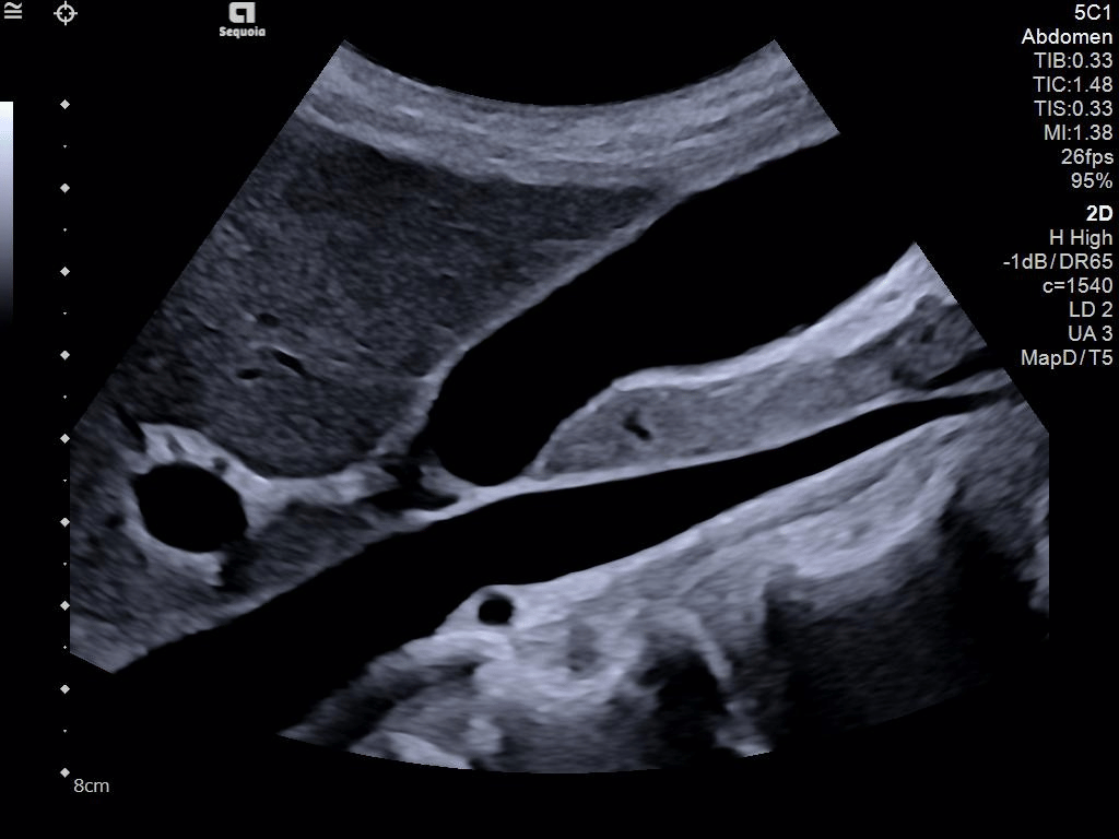 Sagittal 5C1 image of the liver, gallbladder and inferior vena cava demonstrates excellent detail and contrast resolution utilizing the harmonic high setting and an UltraArt setting of 3