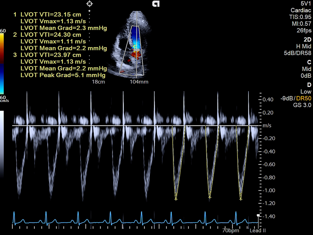 AI Measure on ACUSON Sequoia ultrasound system