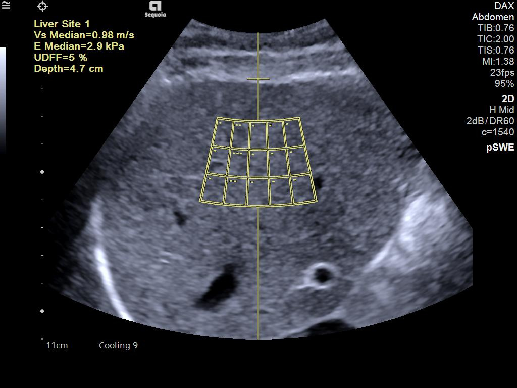 Auto pSWE liver elastography on ACUSON Sequoia