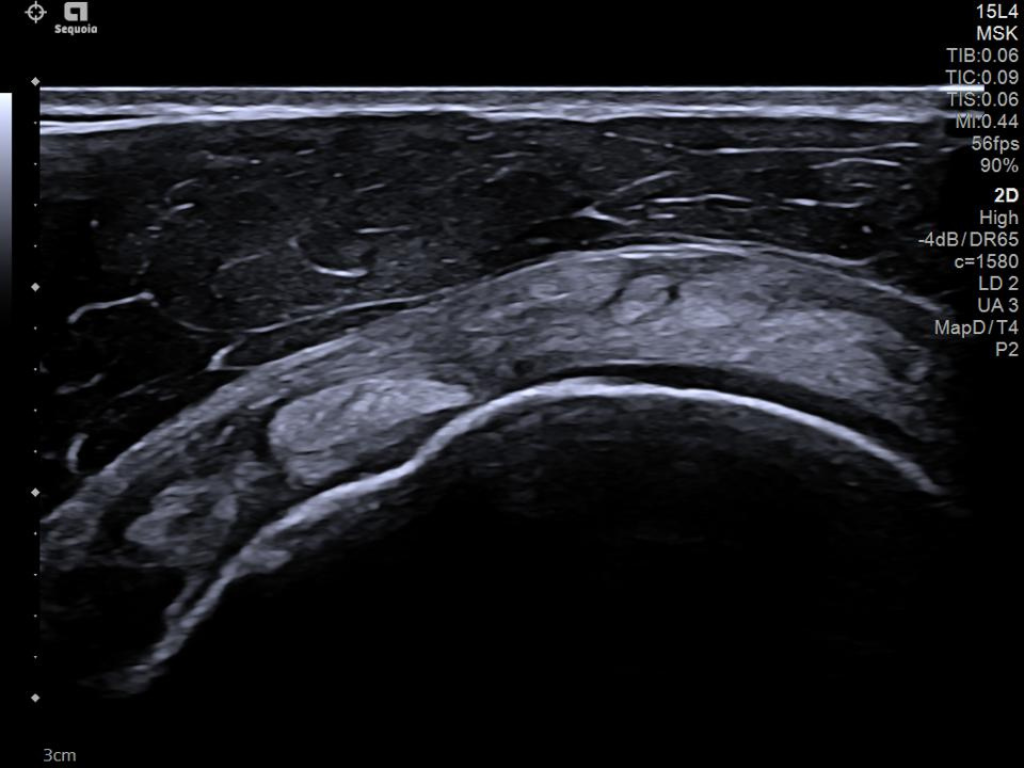 Supraspinatus tendon on the ACUSON Sequoia