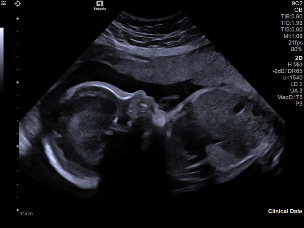 obstetric imaging on the ACUSON Sequoia