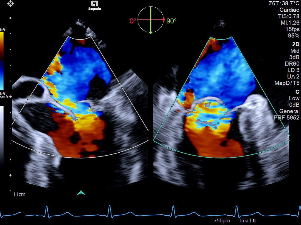 Bi-Plane+ image of mitral valve prolapse with color Doppler demonstrating severe regurgitation utilizing the Z6T transesophageal transducer.