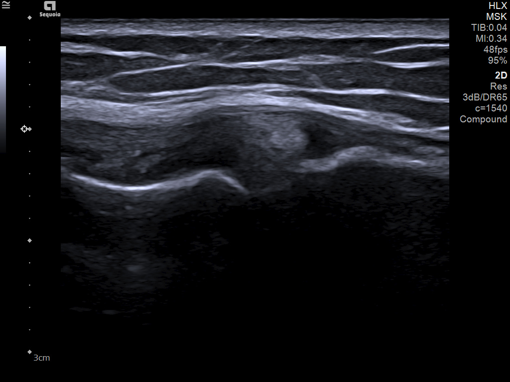 medial collateral ligament (MCL) 