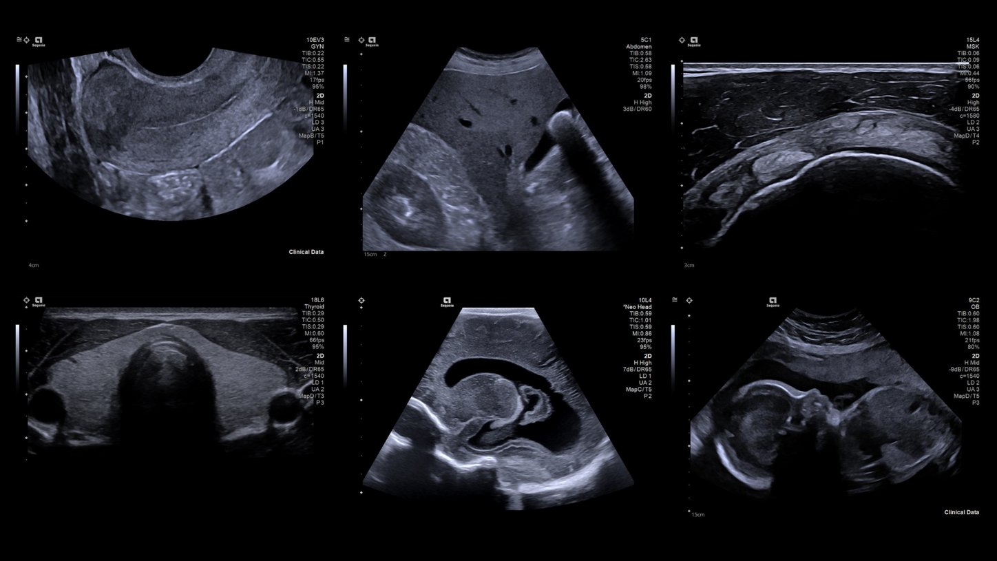 InFocus Imaging on the ACUSON Sequoia
