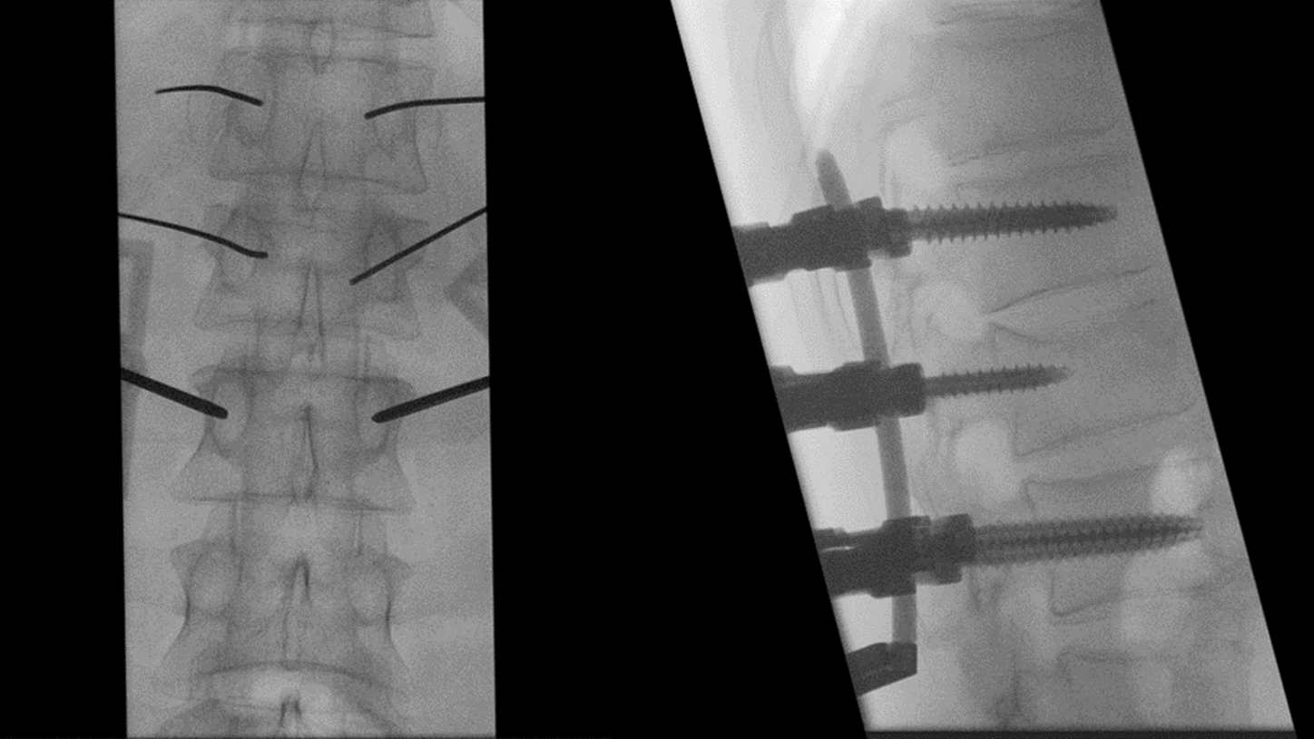 Unstable L1 fracture (AO Spine: A3): Minimally invasive posterior stabilization with a screw-rod-system.