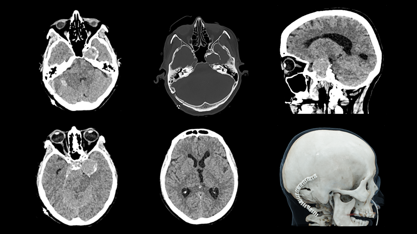 Scan results featuring a cerebral bleeding taken by SOMATOM On.site at 120 kVp.