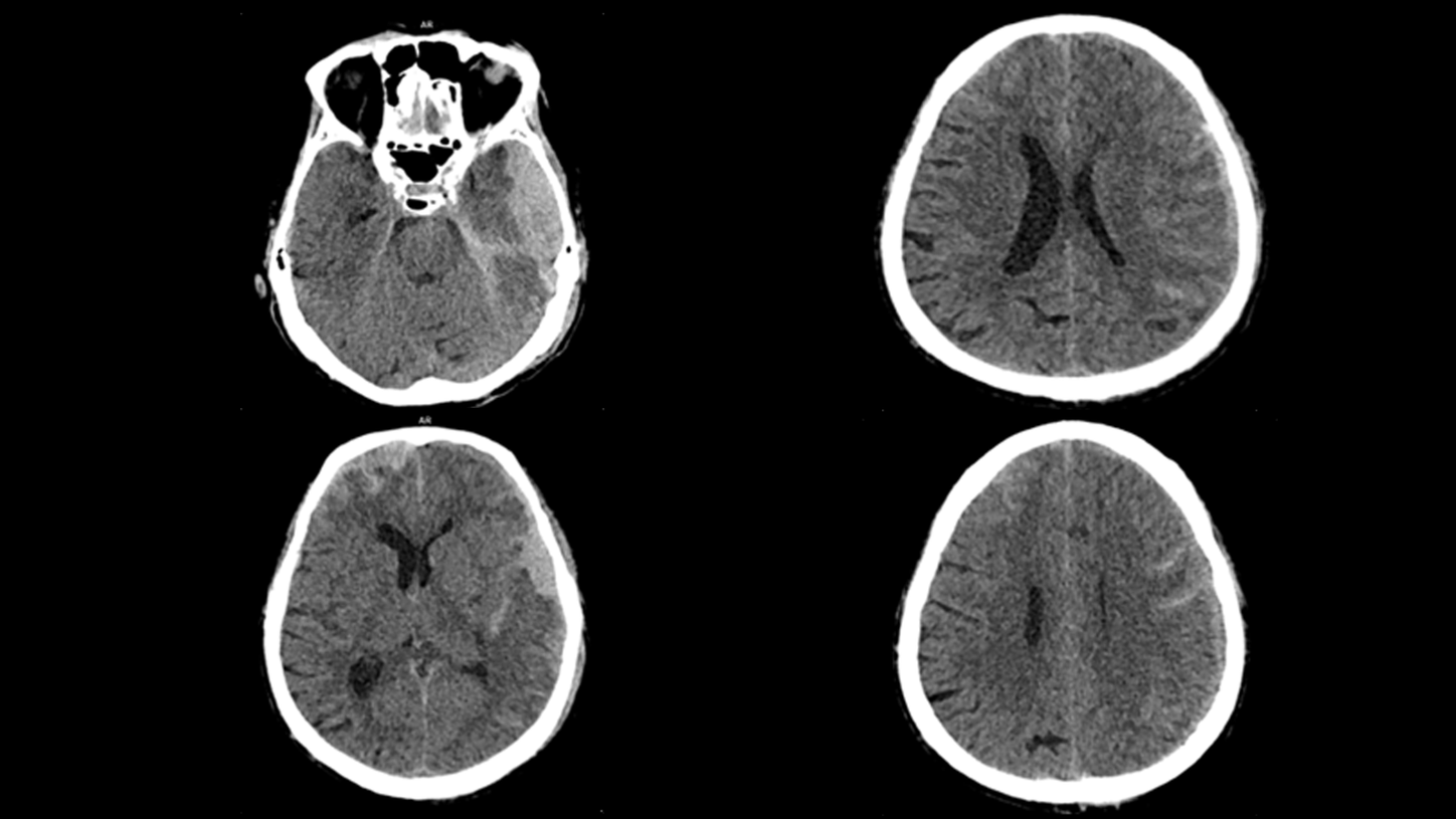 SOMATOM On.site supports triage and treatment decisions through high-end head CT image quality, enabling reliable bleeding detection or exclusion.