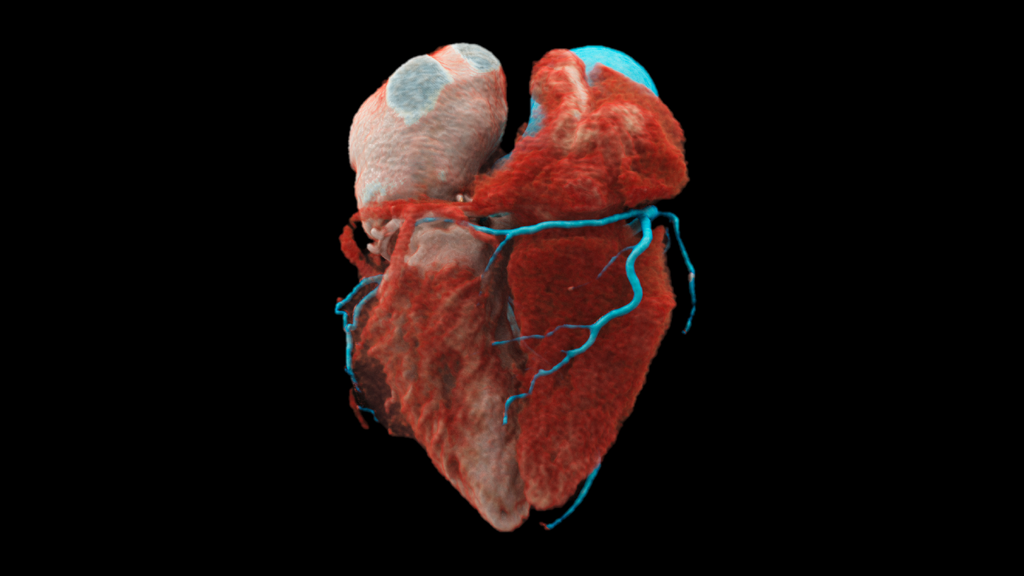 Coronary view of a Quantum HD cardiac cVRT image acquired by a NAEOTOM Alpha photon-counting CT scanner.