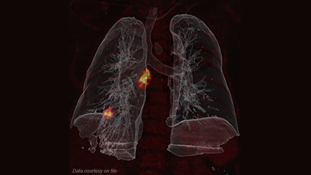 OncoFreeze AI - Deviceless motion management for PET imaging - PET/CT lung scan