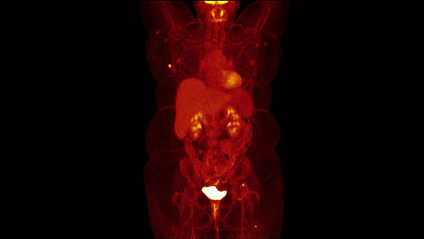 mi petnet breast cancer clinical image